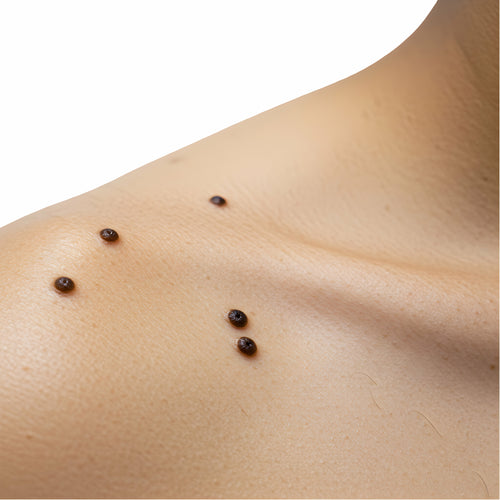 Bovie Procedures