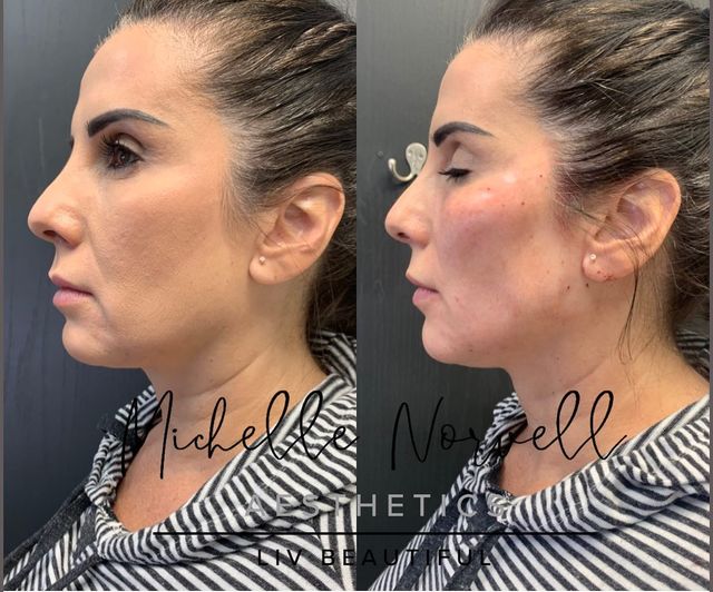 Thread Lift Package with 1 Complimentary Filler