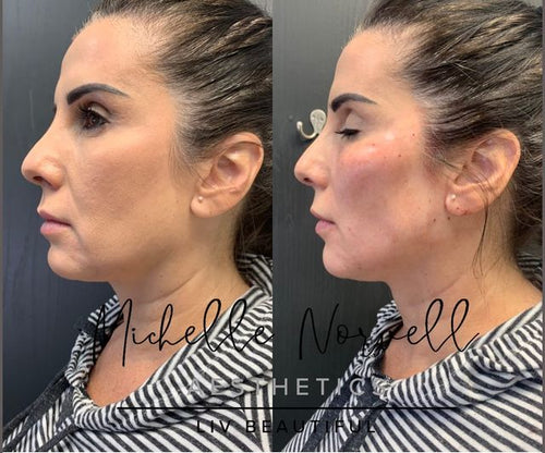 Thread Lift Package with 1 Complimentary Filler